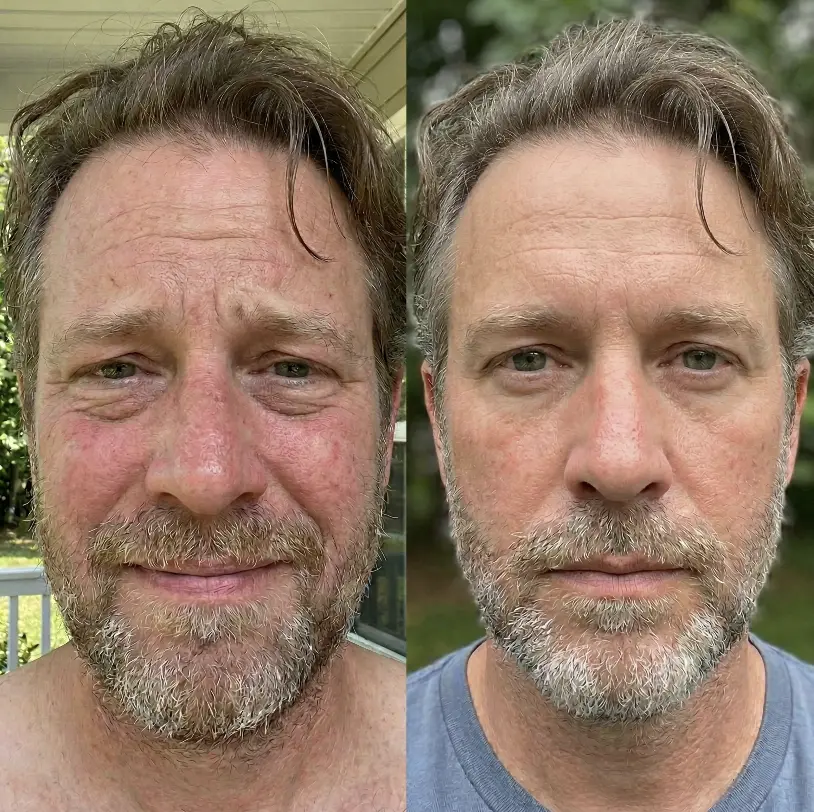 Face transformation before and after